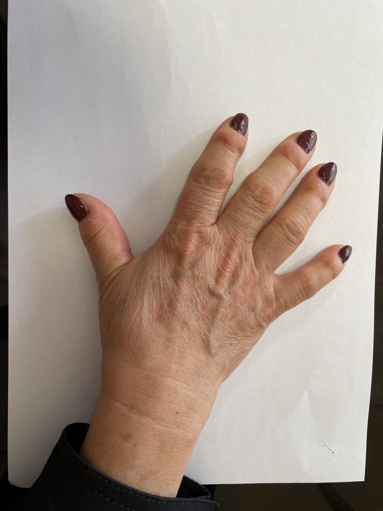 Trattamento della Rizoartrosi
