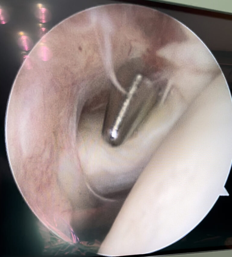Anatomia artroscopica della spalla